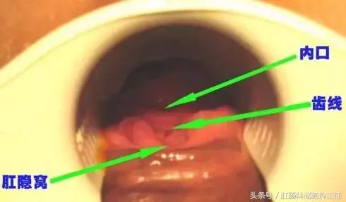 肛瘘怎么治疗好？专业医生也在看的肛瘘治疗指南