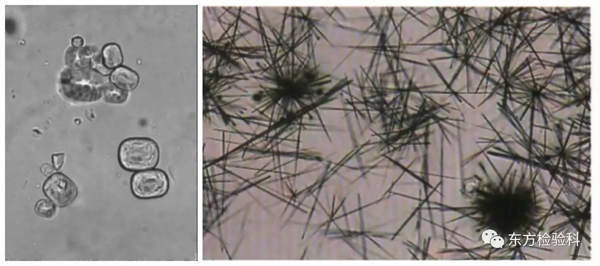 尿中结晶达到多少就是结石了,尿结晶数高是病吗