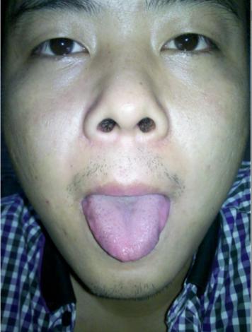 拔火罐出水泡是体内湿气重了吗,拔火罐有水泡湿气重怎么调理