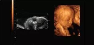 孕期做四维彩超宝宝不配合怎么办,四维产检宝宝不配合怎么办