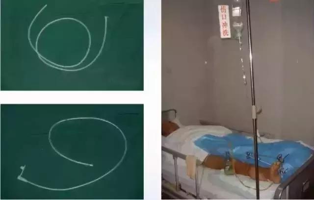 如何促进感染创面的愈合,创面感染怎么办