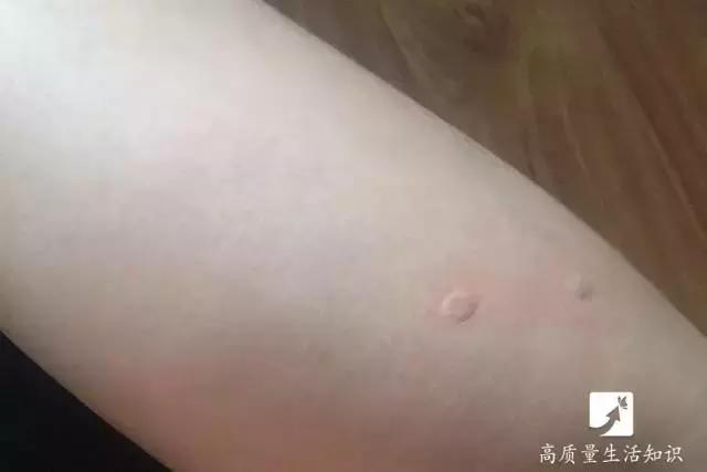蚊子咬后奇痒快速止痒,蚊子叮了怎么能快速止痒