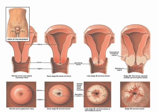 宫颈癌疫苗可以100%预防宫颈癌吗,宫颈癌疫苗可以有效预防宫颈癌吗