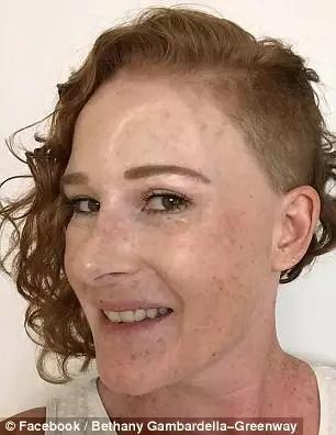 澳女脸上长了个黑包，竟是皮肤癌！只能用腿部皮肤移植到额头！