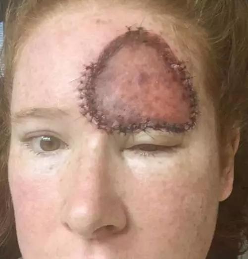 澳女脸上长了个黑包，竟是皮肤癌！只能用腿部皮肤移植到额头！