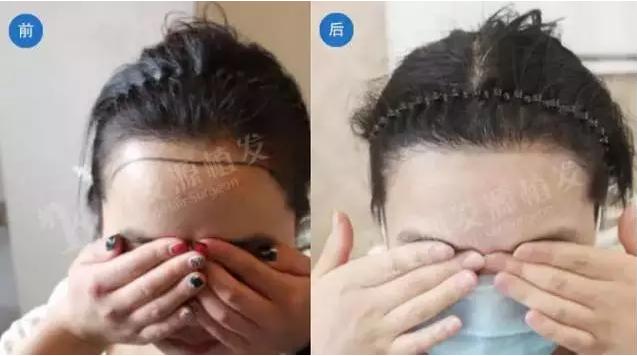 怎么样的发际线为圆形,怎么样的发际线适合长发