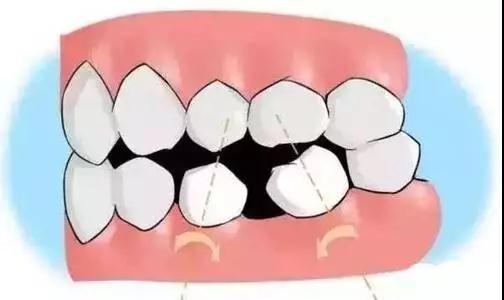 长智齿时需注意什么防止智齿长歪,有什么办法避免长智齿