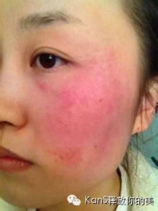 慎入！春季多发激素脸！你还要不要脸？