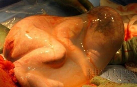 剖腹产后要照顾好自己,剖腹产后第一次下床妈妈心疼