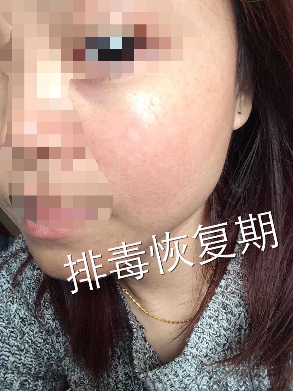 慎入！春季多发激素脸！你还要不要脸？