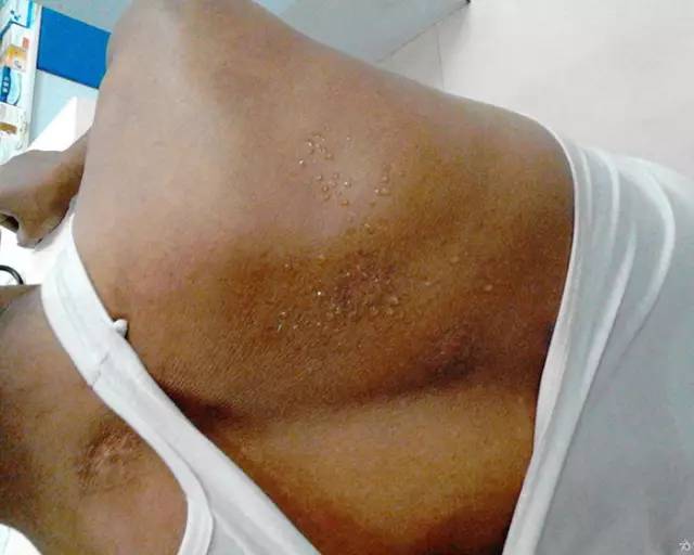 呼吸出现烂苹果味是什么中毒,呼气时有烂苹果气味是什么病