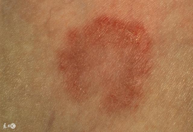 癣的种类分别怎么治疗,癣的诊断