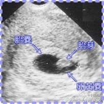 孕妇多久能有胎芽胎心,准妈妈孕早期注意事项