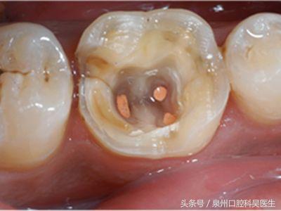 有多少人接受过根管治疗,一分钟带你了解根管治疗
