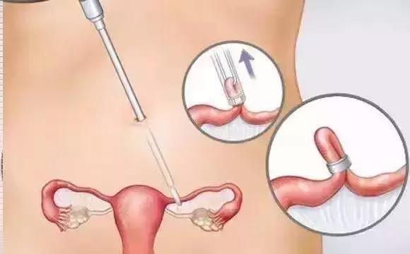 下周就是七夕！现在开始吃避孕药还来得及吗？