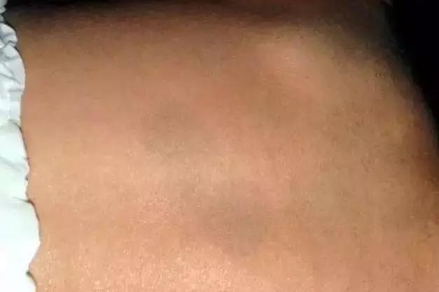 省̥妇̥幼̥专家提醒，宝宝出生有这些印记，一定要去！医！院！