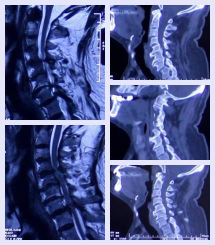 患颈椎管狭窄的病例多吗,颈椎管狭窄最佳睡姿