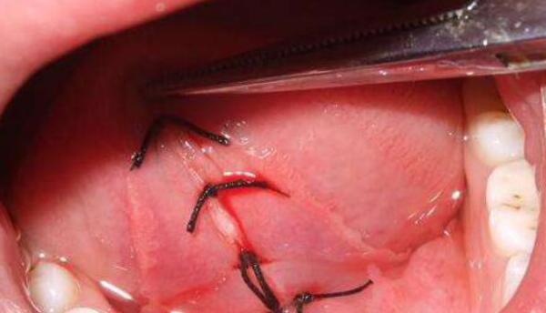 2岁4个月宝宝舌头w型正常吗,1岁宝宝舌头呈w形