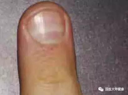 指甲上的月牙预示着什么,指甲上的月牙真的和健康有关系吗