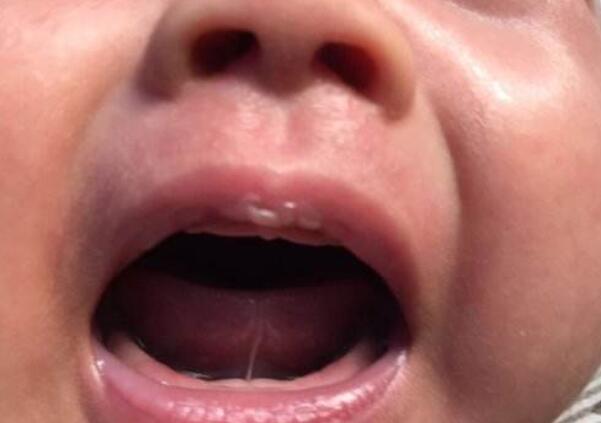 孩子的舌头是w型,宝宝的舌头是w型的应该挂什么科