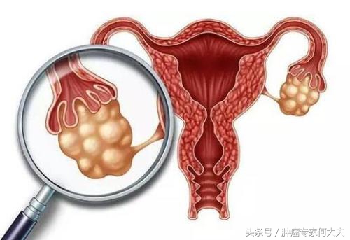 32岁的她如今怎样了,宫颈癌晚期活了50年的真实案例