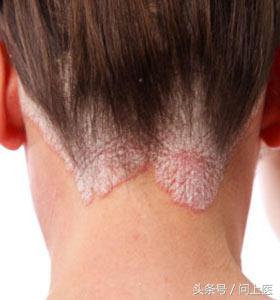 自身免疫性疾病的最新疗法,自身免疫性疾病吃什么药