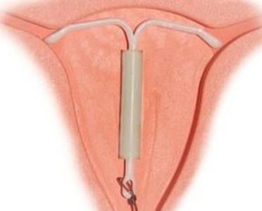 想生二胎什么时候取环最合适,安环十年现在取环怀二胎容易怀吗