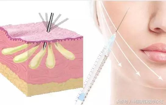线雕面部提升女的,少女线雕术