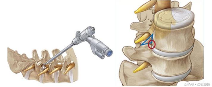 腰椎间盘突出症完全康复不是梦！早诊断、早治疗！