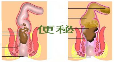 老人连续腹泻一周,老人一直便秘变成拉稀是什么原因