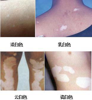 家里两个孩子都长白癜风怎么回事,孩子身上有两块白斑该怎么查