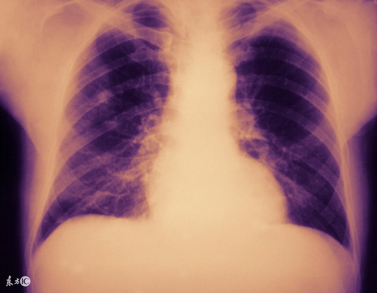 儿童肺炎支原体阳性有传染性吗,支原体肺炎传染性强吗