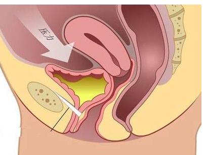 前列腺炎饮食调理方法,前列腺炎哪些食物不能乱吃