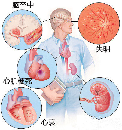 普利和沙坦降压哪种好,普利和沙坦降压效果