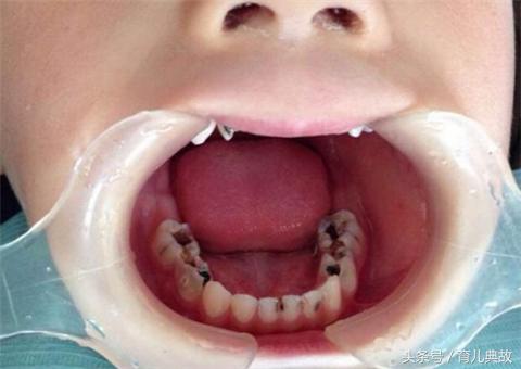 2岁宝宝牙齿龋齿很严重怎么办,大人帮着孩子刷牙还是龋齿怎么办