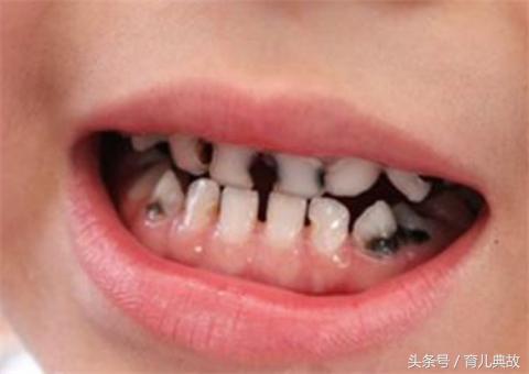 2岁宝宝牙齿龋齿很严重怎么办,大人帮着孩子刷牙还是龋齿怎么办