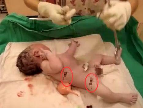 新生儿脐带被医生剪太长了怎么办,刚出生的婴儿被护士剪肚脐