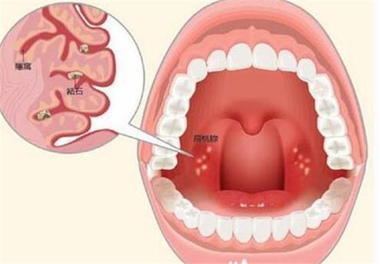 怎么可以彻底治愈扁桃体结石,慢性扁桃体结石怎么治疗最有效