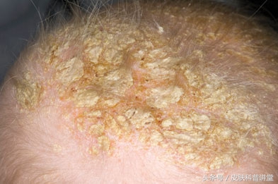 西医认为脂溢性皮炎的原因有什么,脂溢性皮炎发病年龄及发病率