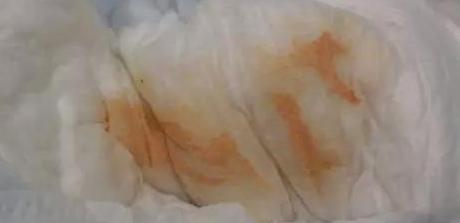 刚出生女宝宝尿布上有血啥原因,新生女宝宝尿布有血