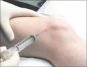 关节肿是滑膜炎吗,有什么病能引起滑膜炎