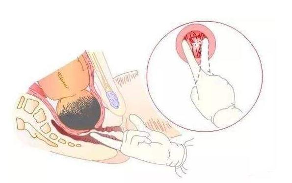 开宫指是医生手开吗,宫开十指是指子宫还是什么