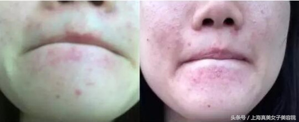 下巴和嘴周围经常冒痘？有对策！