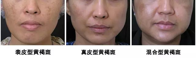 脸上突然出现很多褐斑,脸上褐斑的最好治疗方案