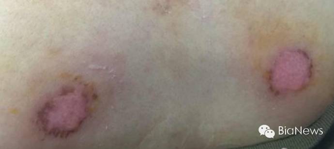 刮痧刮破皮了可要求多少赔偿,刮痧刮掉皮了