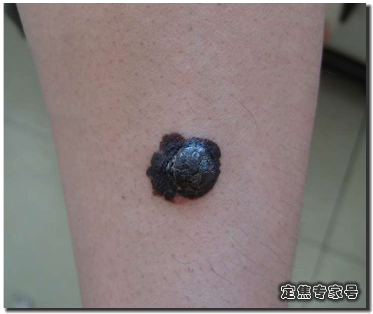 黑痣也算痣吗,怎么判断天生黑痣是好的坏的