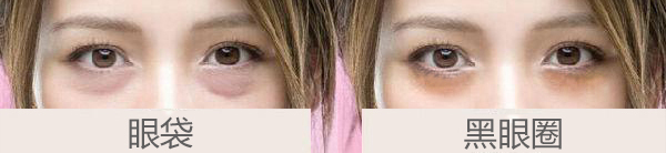 黑眼圈或眼袋很重？20几岁的年纪怎么办？