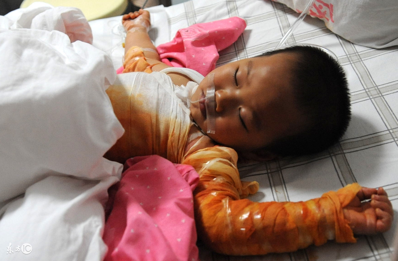 揪心小孩烫伤,孩子被烫伤后父母揪心的痛