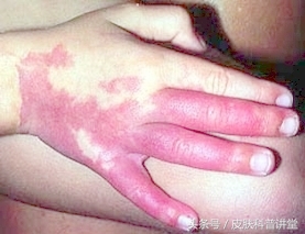 治疗鲜红斑痣胎记最好的医院,鲜红斑痣好治还是红胎记好治