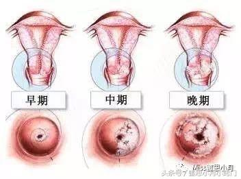 宫颈癌最严重的6个误解,一分钟看懂宫颈癌筛查方法
